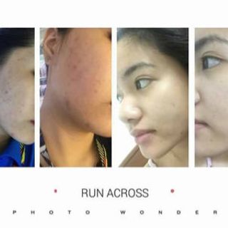 CAO NGHỆ VÀNG ST Trị mụn thâm se khít lỗ chân lông