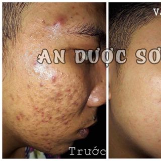 An Dược Sơn - Trị Mụn Thâm Nám Sẹo Rỗ 50ml