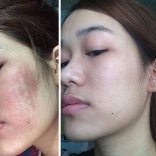 An Dược Sơn - Trị Mụn Thâm Nám Sẹo Rỗ 50ml