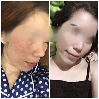 An Dược Sơn - Trị Mụn Thâm Nám Sẹo Rỗ 50ml