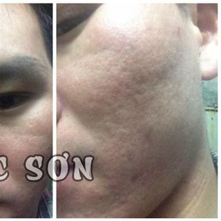 An Dược Sơn - Trị Mụn Thâm Sẹo Rỗ 30ml