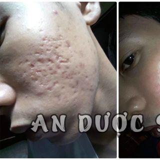 An Dược Sơn - Trị Mụn Thâm Nám Sẹo Rỗ 50ml