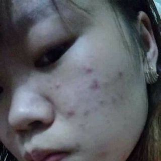 thuốc trị mụn sắc mộc lan