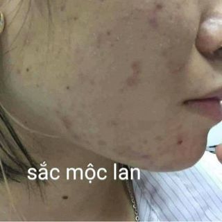 thuốc trị mụn sắc mộc lan