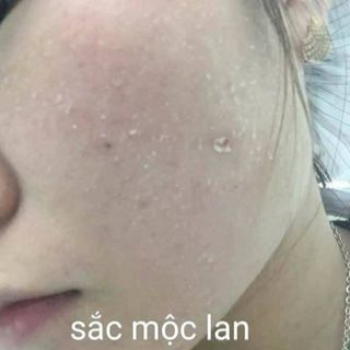 thuốc trị mụn sắc mộc lan