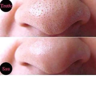 LỘT MỤN DƯỠNG DA 2IN1