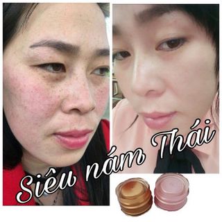 ĐẶC TRỊ NÁM SIÊU HIỆU QUẢ