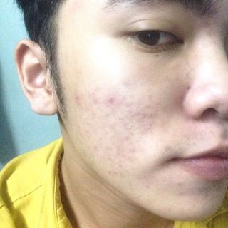 Thuốc trị mụn Đông Y