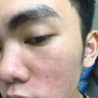 Thuốc trị mụn Đông Y