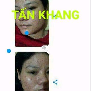 Đặc trị mụn nám Tấn Khang