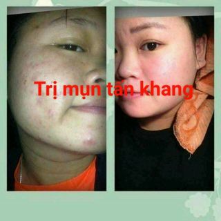Đặc trị mụn nám Tấn Khang