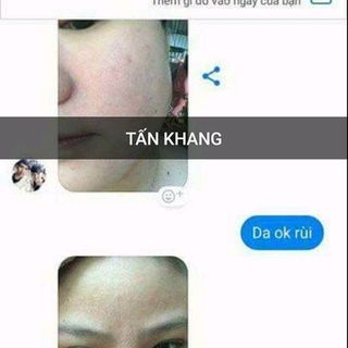 Đặc trị mụn nám Tấn Khang
