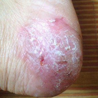 Thuốc đặc trị bệnh viêm da cơ địa 999