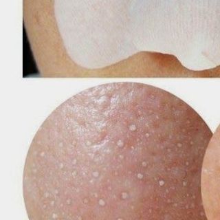 Gia công bán sỉ lẻ Tinh Chất Ủ Mụn Cámnước lột lạnh lột da collagenkem body trắng datắm trắng