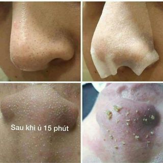 Gia công bán sỉ lẻ Tinh Chất Ủ Mụn Cámnước lột lạnh lột da collagenkem body trắng datắm trắng