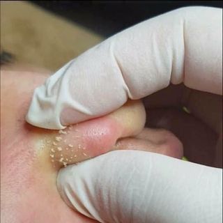 Gia công bán sỉ lẻ Tinh Chất Ủ Mụn Cámnước lột lạnh lột da collagenkem body trắng datắm trắng