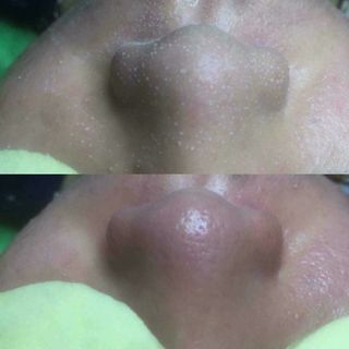 Gia công bán sỉ lẻ Tinh Chất Ủ Mụn Cámnước lột lạnh lột da collagenkem body trắng datắm trắng