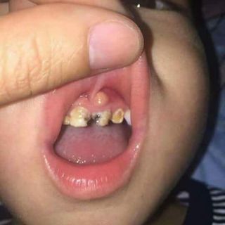 đặc trị xâu răng hôi miệng
