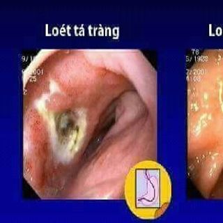 TỲ KHANG BÌNH VIH ĐAN
