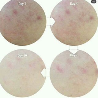 Huyền dịch trị mụn cấp tốc