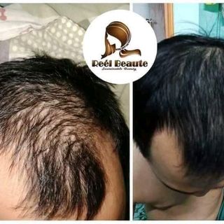 TÚI LỌC GỘI ĐẦU TRỊ RỤNG TÓC