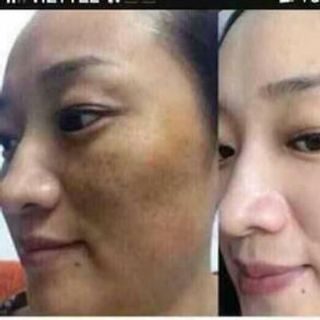 Kem Face Zoley Tím-Thần Dược trị Nám