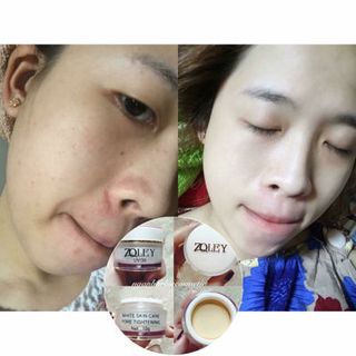 Kem Face Zoley Trắng-dưỡng trắng-trị thâm-se khít lỗ chân lông