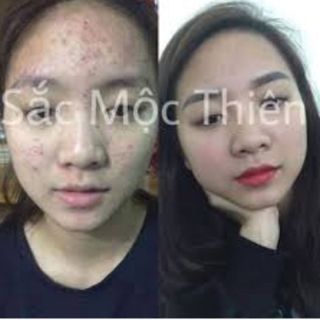 Mỹ phẩm trị mụn Sắc Mộc Thiên