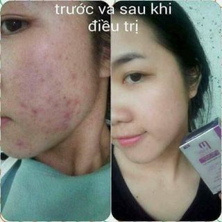 trị mụn MWHITE