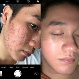 Trị mụn sắc mộc thiên