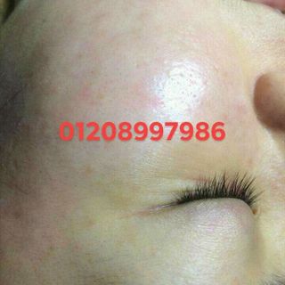 bộ trị nám hoàng cung huế