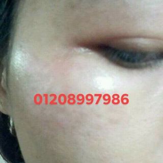 bộ trị nám hoàng cung huế