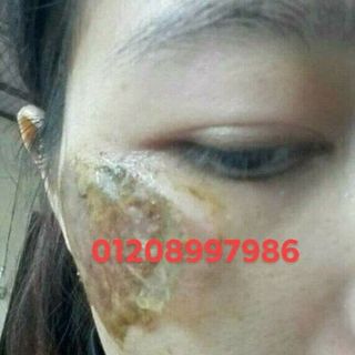bộ trị nám hoàng cung huế