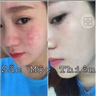 Trịmụn Sắc mộc thiên