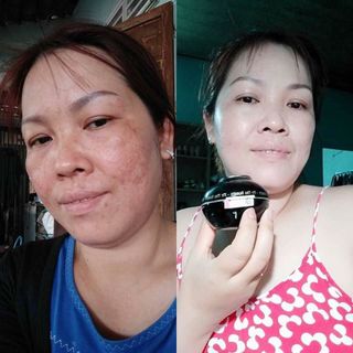 KEM ĐẶC TRỊ NÁM TÀN NHANG MY MIU