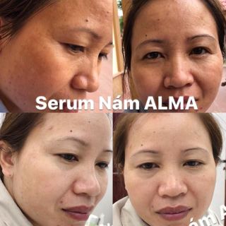 Serum trị nám tàn nhang Alma