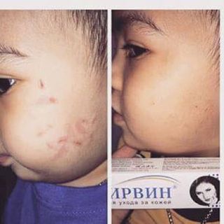 KEM TRỊ SẸO NGA KLIRVIN