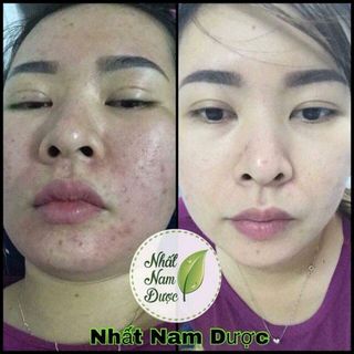 Thảo Dược tái tạo Da Nhất Nam Dược