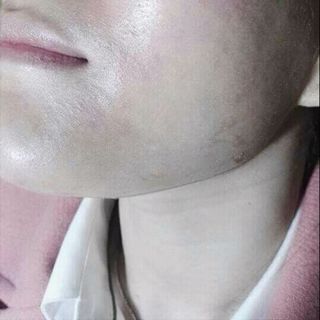 bộ trị nám gia truyền hoàng cung huế