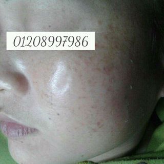 bộ trị nám gia truyền hoàng cung huế
