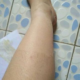 Wax triệt lông vĩnh viễn