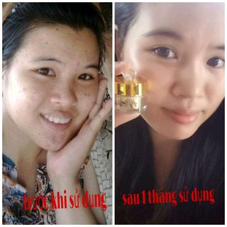 kem face đặc trị mụn VY BARBIE