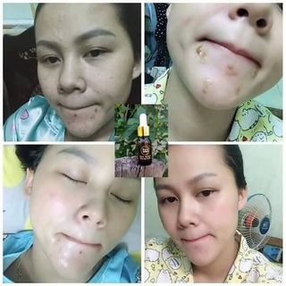 KEM ĐẶC TRỊ MỤN MY MIU