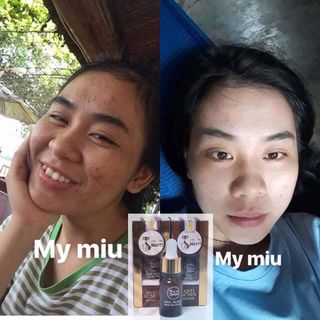 KEM ĐẶC TRỊ MỤN MY MIU