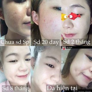KEM ĐẶC TRỊ MỤN MY MIU