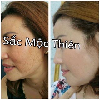 Thuốc Đông Y Trị Mụn Sắc Mộc Thiên
