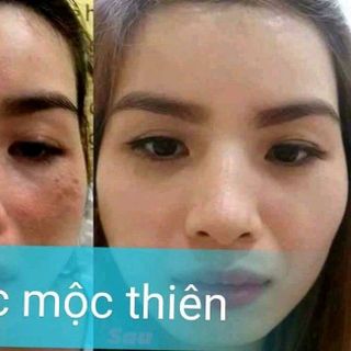 Thuốc Đông Y Trị Mụn Sắc Mộc Thiên