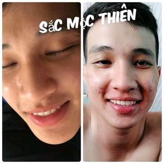 Thuốc Đông Y Trị Mụn Sắc Mộc Thiên