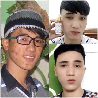 Mặt nạ thải mụn
