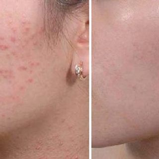 Serum Dew Dew Acne Treatment 30ml – Serum trị mụn Hàn Quốc